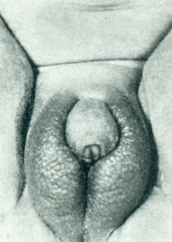 Hypertrophie du clitoris et des grandes lèvres 