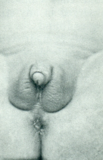 Hypertrophie modérée du clitoris et vulve normale